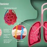 Interstitial Lung Diseases service image